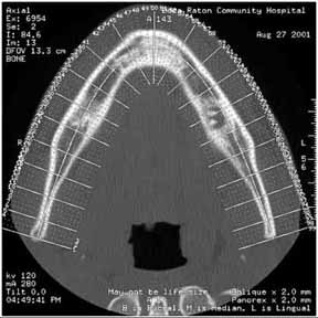 mandible