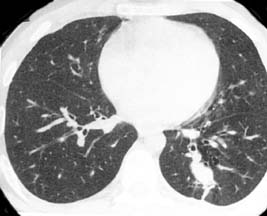 lung cancer cat scan